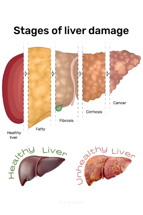 Best doctors for liver disease treatment in hyderabad best fatty liver treatment in hyderabad best hospital for liver treatment in hyderabad best hospital in hyderabad for liver treatment best liver treatment hospital in hyderabad best liver treatment in hyderabad cupping for liver detox doctor for fatty liver in hyderabad hijama for fatty liver hijama for liver detox hijama for liver disease liver treatment hospital in hyderabad liver treatment in hyderabad liver treatment in hyderabad cupping liver detox cupping therapy for fatty liver cupping therapy for liver