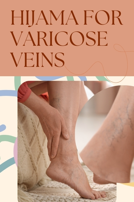 Cupping on varicose veins hijama for varicose veins spider veins natural treatment varicose vein clinic hyderabad telangana varicose vein in telugu varicose vein treatment hyderabad varicose vein treatment in hyderabad varicose veins bodybuilding varicose veins hands varicose veins specialist in hyderabad