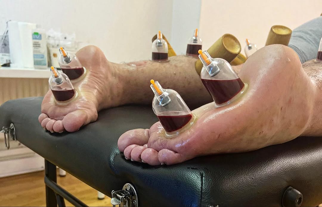 Knee pain natural treatment natural knee pain treatment cupping on knee knee joint pain treatment in hyderabad cupping knee pain cupping therapy knee pain knee pain treatment hyderabad cupping therapy for knee pain knee pain hospital in hyderabad knee pain specialist in hyderabad best knee pain treatment in hyderabad hijama for knee pain knee treatment without surgery in hyderabad knee pain cupping therapy cupping knee arthritis hijama therapy for knee pain wet cupping for knee pain advanced spine and knee hospital banjara hills hijama treatment for knee pain knee pain treatment in hyderabad