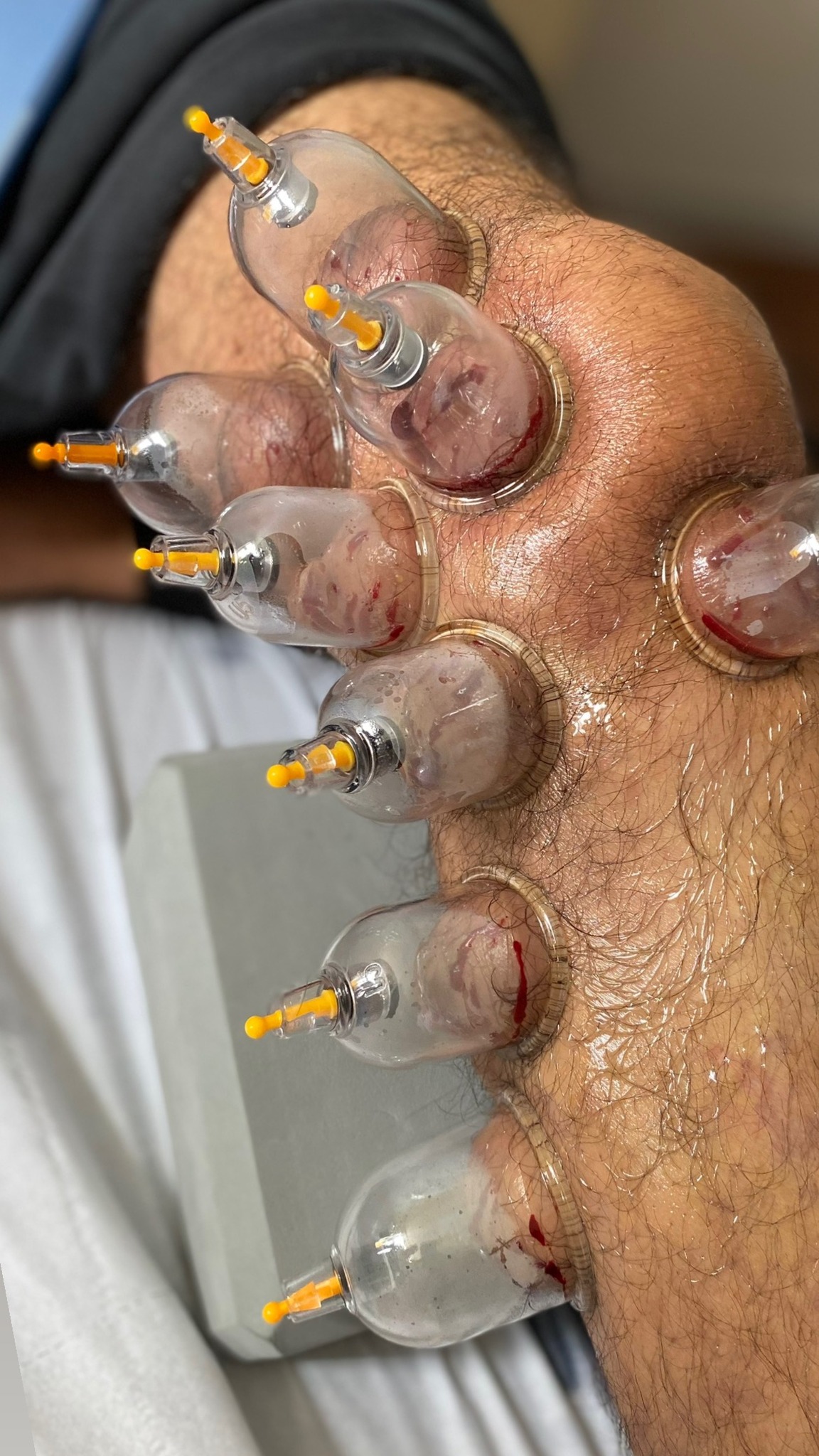 Arthritis cure arthritis in feet treatment arthritis in hands treatment arthritis in hindi treatment arthritis joint pain treatment arthritis rheumatoid treatment arthritis treatment in hyderabad arthritis treatment knee pain best arthritis treatment in hyderabad best doctor for rheumatoid arthritis in hyderabad best rheumatoid arthritis doctor in hyderabad best rheumatoid arthritis treatment cupping knee arthritis cupping therapy for arthritis cupping therapy for arthritis treatment cupping therapy rheumatoid arthritis cupping treatment for arthritis hand arthritis treatment in hyderabad hijama cupping for arthritis knee arthritis cupping knee arthritis treatment without surgery latest treatment for rheumatoid arthritis natural treatment arthritis rheumatoid arthritis best doctors in hyderabad rheumatoid arthritis best treatment in india rheumatoid arthritis doctor in hyderabad rheumatoid arthritis muscle pain treatment rheumatoid arthritis natural cure rheumatoid arthritis natural treatment rheumatoid arthritis new treatment rheumatoid arthritis pain treatment rheumatoid arthritis permanent treatment rheumatoid arthritis specialist in hyderabad rheumatoid arthritis symptoms and treatment rheumatoid arthritis treatment for fingers rheumatoid arthritis treatment hindi rheumatoid arthritis treatment in hyderabad tm joint arthritis treatment treatment for acute gouty arthritis treatment for arthritis of the knee treatment for foot arthritis treatment for psoriasis arthritis treatment for rheumatoid arthritis in fingers treatment for rheumatoid arthritis of the knee treatment for seronegative arthritis treatment of ankle arthritis treatment of gout arthritis treatment of tmj arthritis what is the latest treatment for rheumatoid arthritis what is the treatment of rheumatoid arthritis what is treatment for rheumatoid arthritis which treatment is best for rheumatoid arthritis