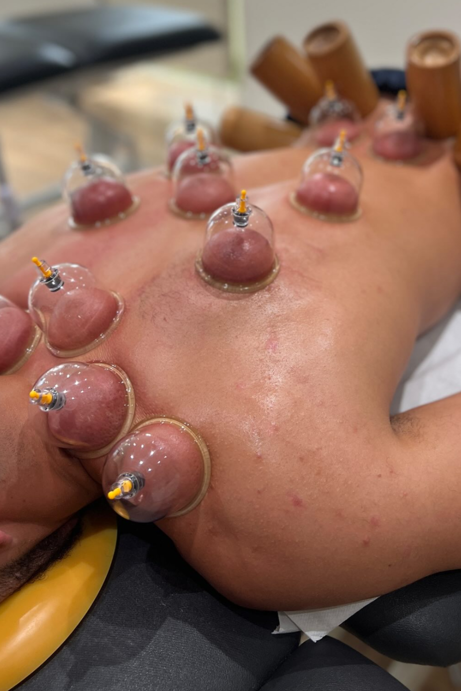 Cupping treatment for back pain specialist in hyderabad alhadeh hijama centre