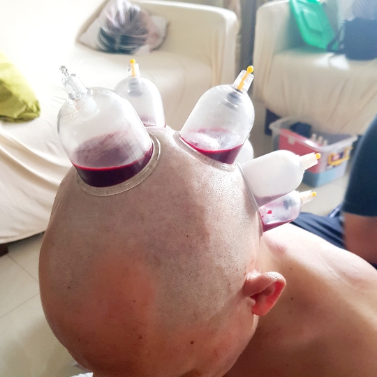 Best hair fall treatment in hyderabad best hair treatment hyderabad cupping for hair growth hair fall treatment in hyderabad hijama for hair fall hijama for hair growth hijama for hair loss