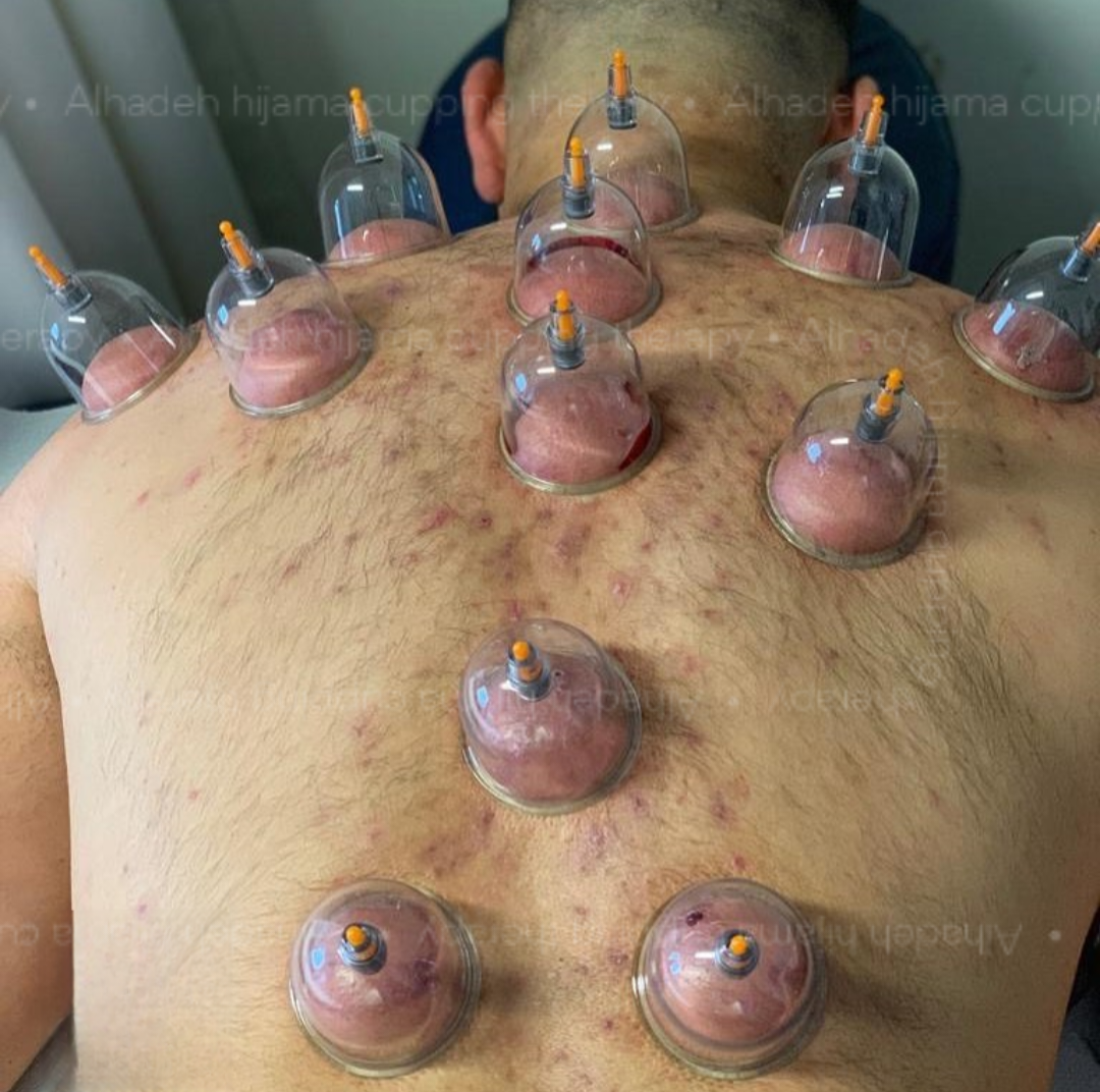 Best psoriasis treatment in hyderabad cupping for psoriasis hijama for psoriasis hijama for scalp psoriasis hijama psoriasis psoriasis best treatment in hyderabad treatment for psoriasis in hyderabad
