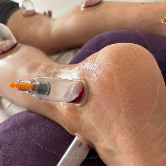 Cupping foot pain cupping for foot pain cupping therapy on foot foot and ankle specialist in hyderabad foot cupping foot doctor in hyderabad foot specialist in hyderabad hijama for foot pain hijama on foot