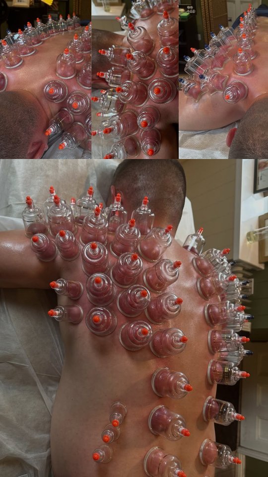 Hijama for diabetes treatment in hyderabad at alhadeh hijama clinic