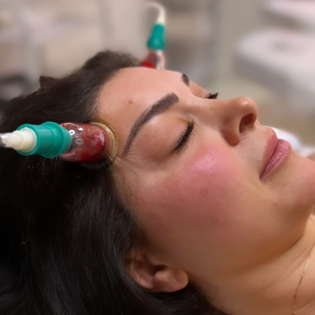 Face cupping for sinus in hyderabad | alhadeh best hijama centre hyderabad | cupping therapy in hyderabad Chronic sinusitis treatment with cupping cupping for sinus specialist hyderabad