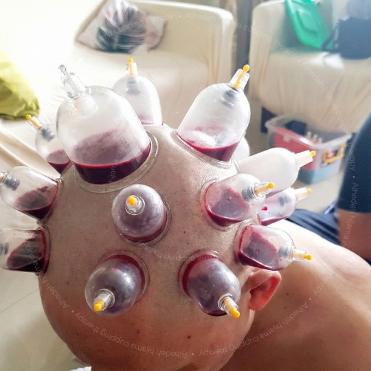 Hijama for baldness treatment hyderabad
